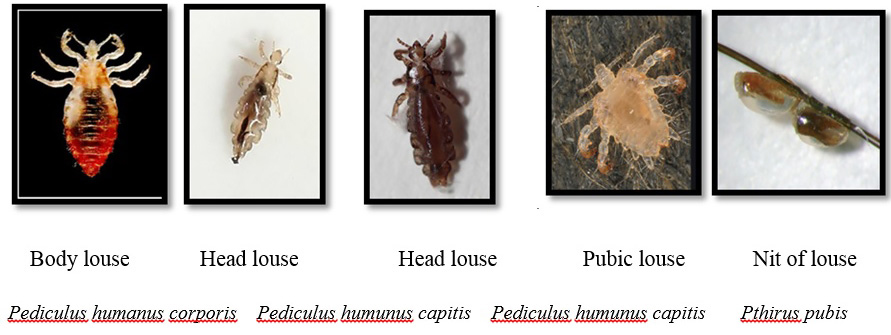 pediculosis corpus