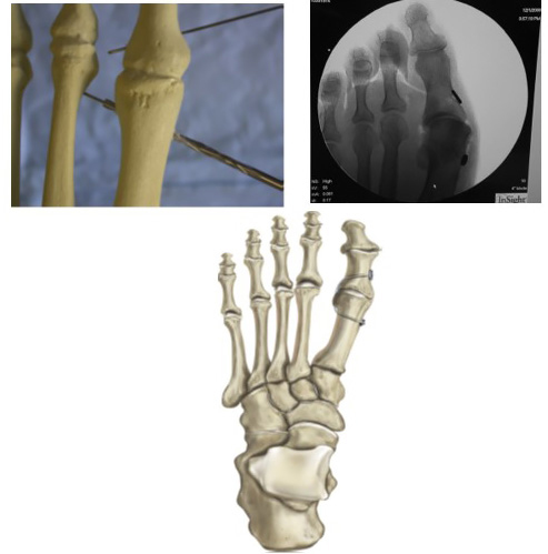 hallux varus repair